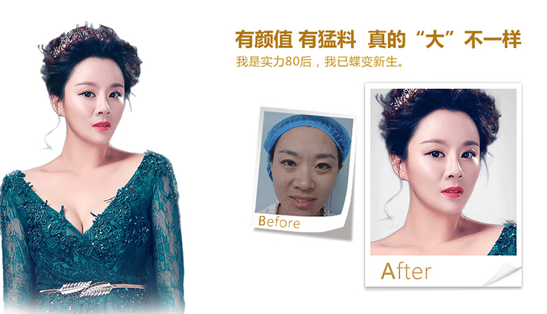 郴州脂肪移植、隆鼻